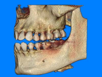 Insights Diagnostic CBCT Scan Services 8 x 8 cm (half face maxilla + mandible)